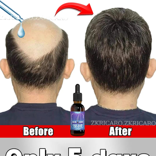 ZKRICARO 0fficial genuine, high quality hair growth essence 0il, scalp care, make hair grow thicker, no more baIIdness